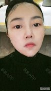 成都硅胶隆鼻好